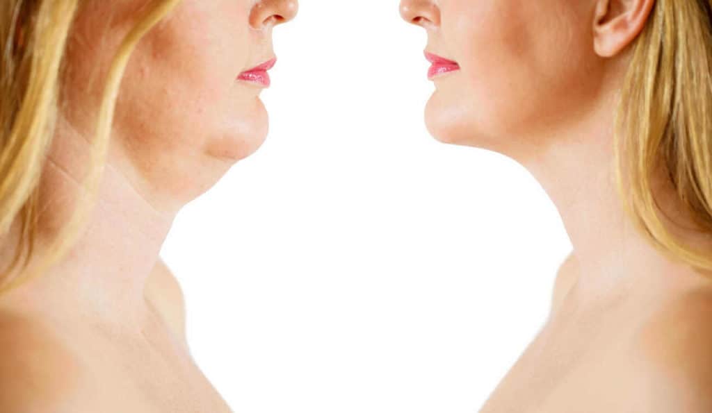 Double Chin treatment Brixton before and after results