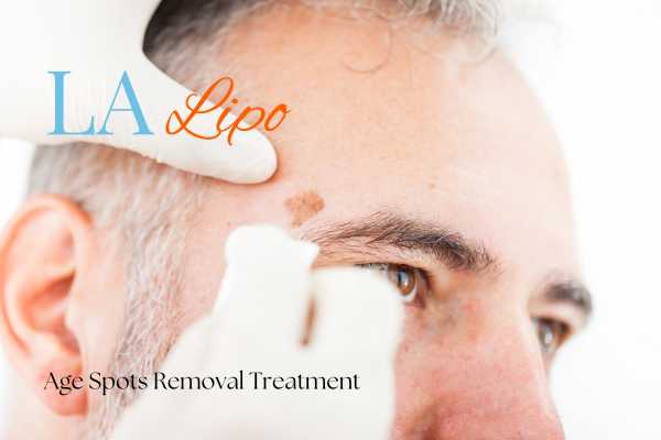 What Are the Most Effective Treatments for Age Spots Brixton?