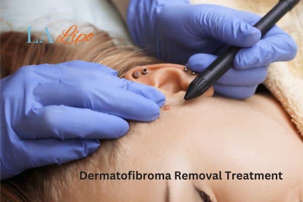 Dermatofibroma Removal Treatment Brixton