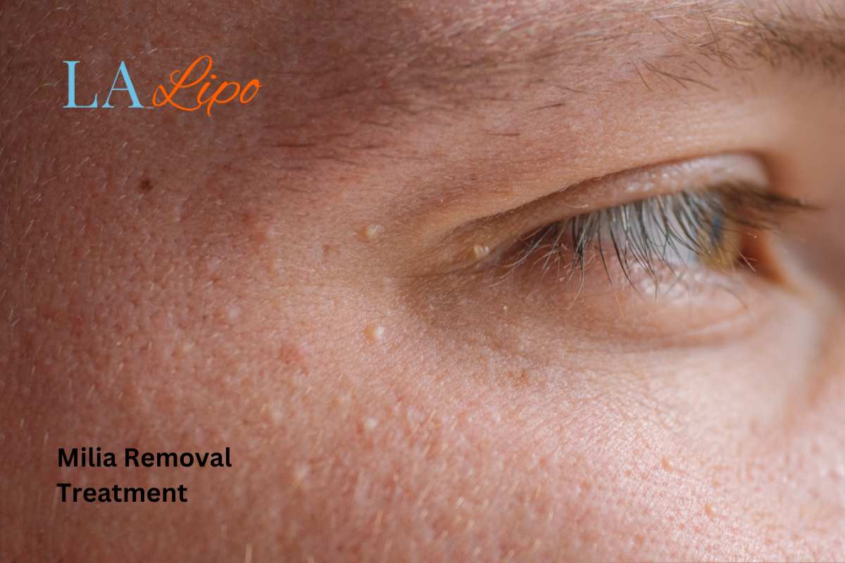 Cryopen Milia Removal: Is It the Easiest and Safest Option Brixton?