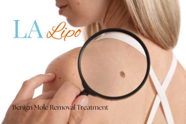 Why getting moles removed Brixton can boost your confidence!