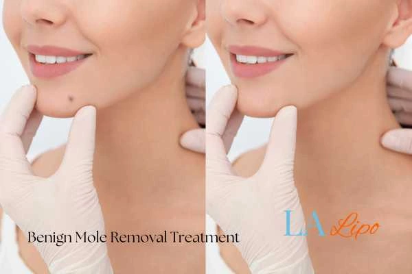 woman's before and after mole removal Brixton results