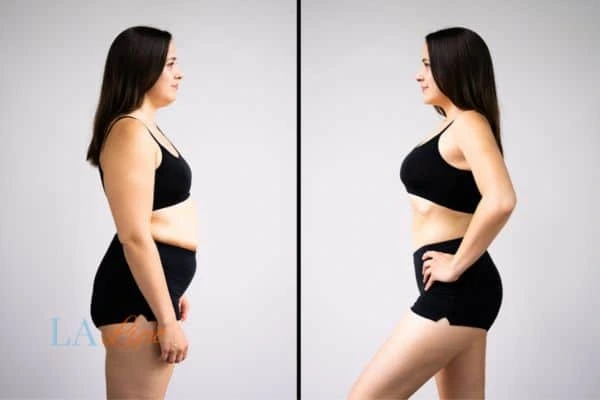 image of woman before and after results of LA-EMS Body Sculpting Brixton to help treat Diastasis recti