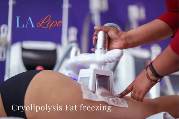 women getting fat freezing Brixton