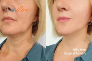 hi-fu for wrinkles Brixton before and after results