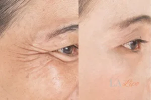 Before and after results of woman - HI-fu wrinkles reduction treatment Brixton