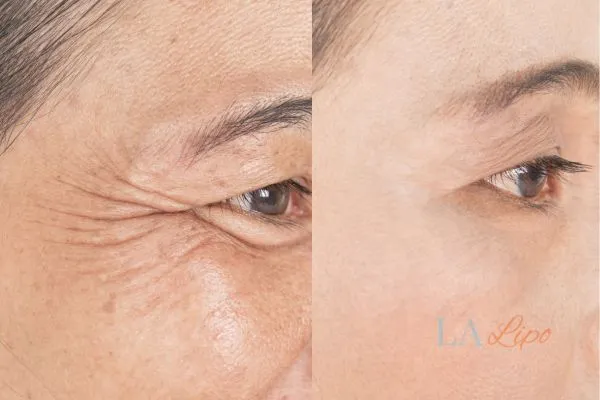 Before and after results of woman - HI-fu wrinkles reduction treatment Brixton