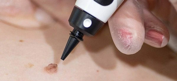 skin tag removal using cryopen Brixton