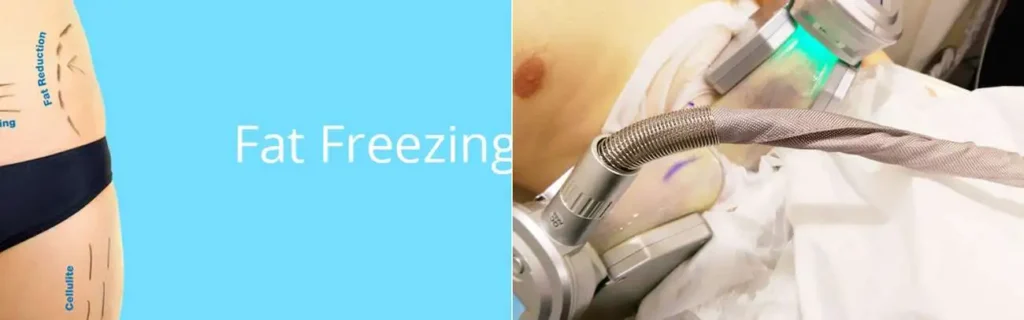 Fat freezing Brixton on multiple areas of the body