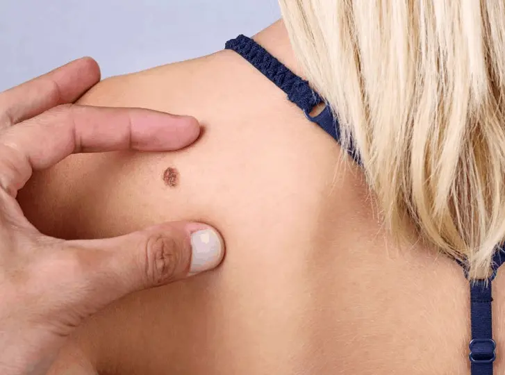woman having mole removal Brixton consultation before treatment.