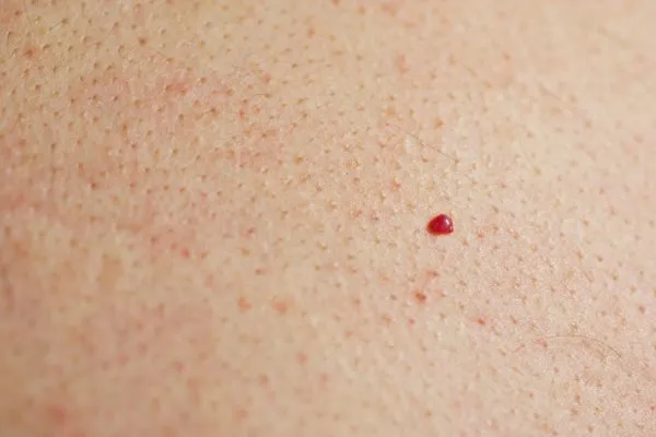 close up of a cherry angioma Brixton