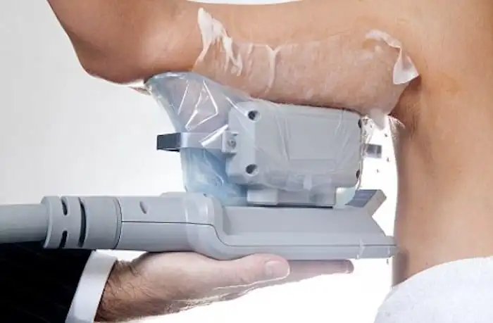 Picture of fat freezing Brixton on the upper arms.