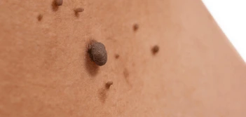 image of a skin tag Brixton