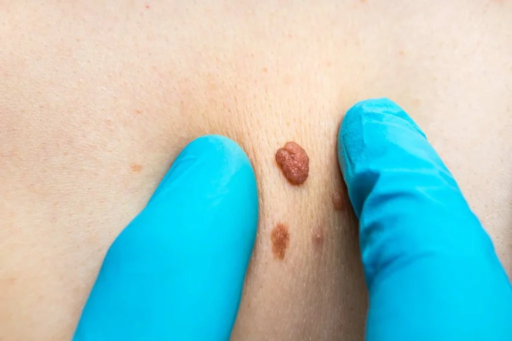 Consultant examining a skin tag Brixton