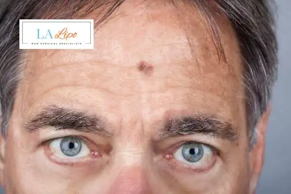 Solar Lentigo Removal Brixton image of man with mark on his forehead