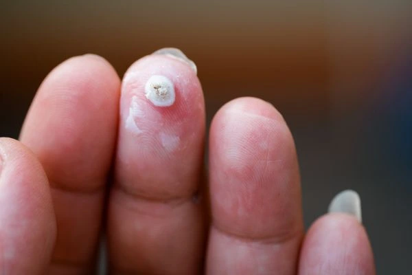 wart on person finger - cryotherapy to treat from LA LIPO Brixton