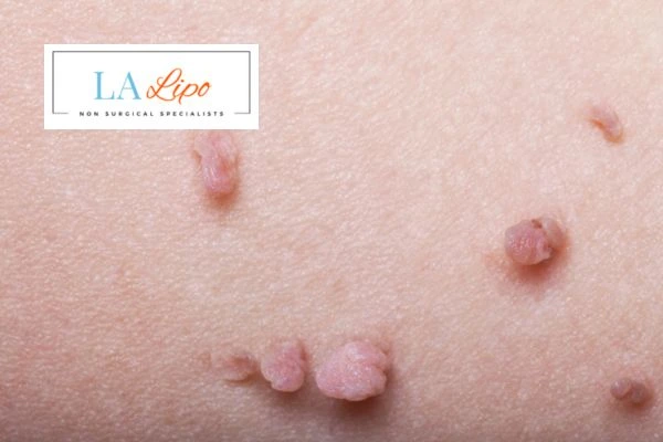 Does cryopen skin tag removal Brixton hurt? Find out now call our team today!