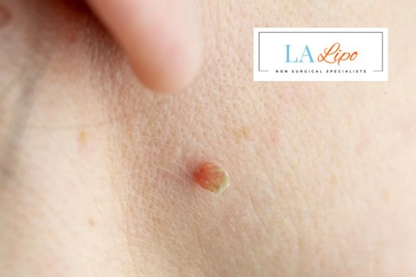 Book skin tag removal Brixton today speak to our team now!