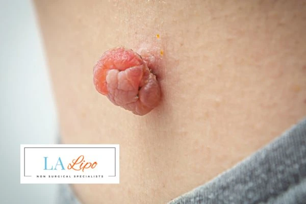 Interested in skin tag removal Brixton? Concerned about the pain? Find out more today!