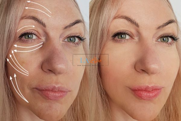 Morpheus 8 results Brixton face lift.