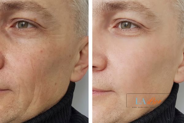 See the amazing results of Morpheus8 Treatment Brixton!