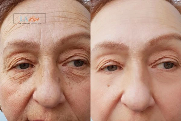 The powerful benefits of Morpheus8 Treatment Brixton - Call Our team today!
