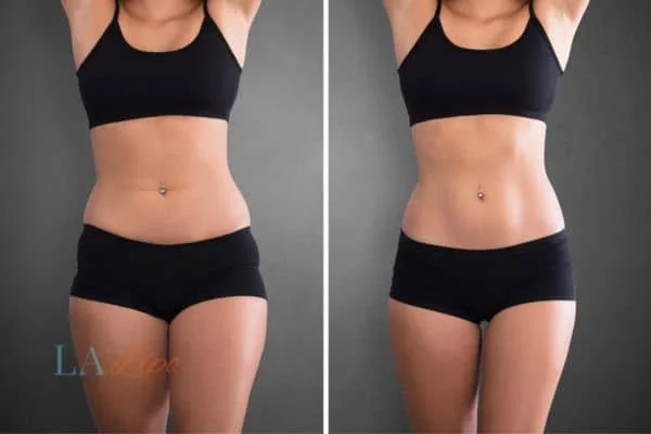 before and after results of non-surgical treatment to help a woman's body image and mental health Brixton