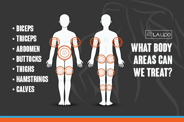 Diagram to show areas you can have LA-EMS Body Sculpting Treatment Brixton