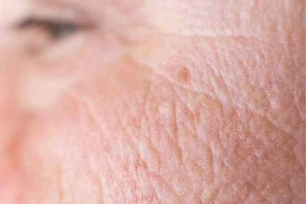 close up picture of a woman's face showing an age spot Brixton