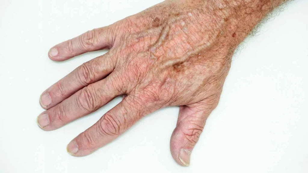 Male hand showing age spot Brixton