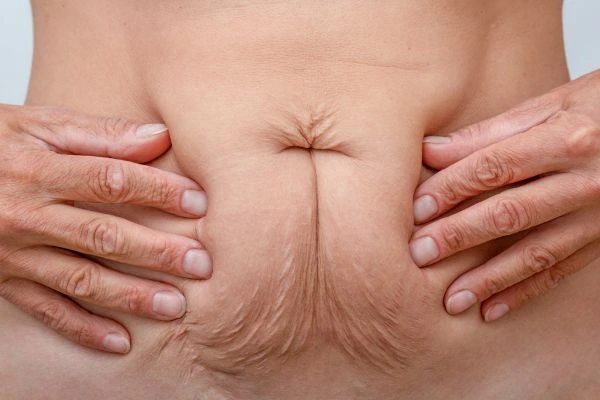 Image of a woman's stomach with loose skin - example of skin tightening Brixton options