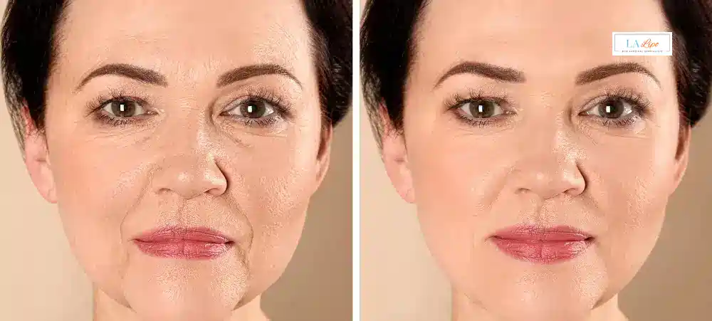 How Long Does It Take to See Results and How Long Do They Last Brixton?