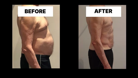 What Symptoms Can Diastasis Recti Cause in Men? Weak Core, Back Pain and Poor Posture Brixton